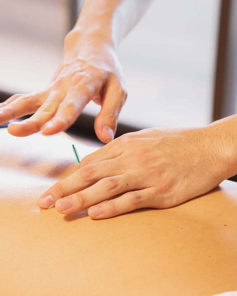 Pose d'une aiguille d'acupuncture au cours d'une séance
