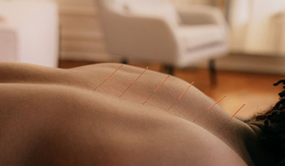 Aiguilles d’acupuncture posées le long du dos pendant une séance